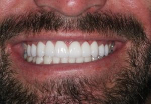 Full Mouth Bleach Veneers