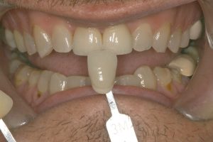 Monolithic Zirconia