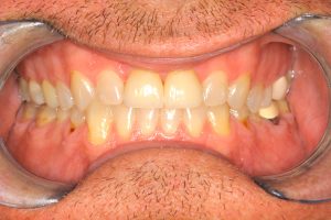 Monolithic Zirconia
