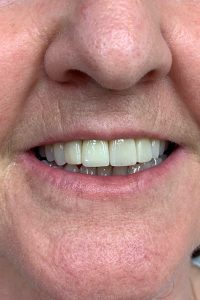 Veneers