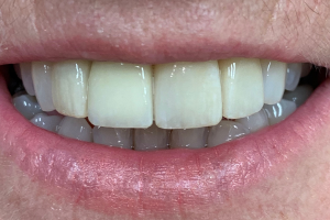veneers – 5