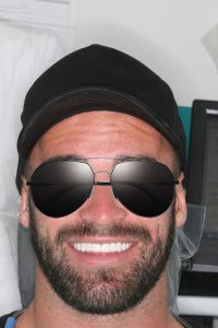 Full Mouth Bleach Veneers V1 img